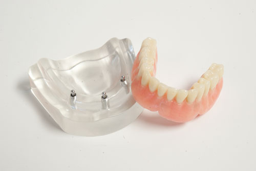 Quels sont les différents types de prothèses dentaires? - Francis Migneault d.d.
