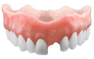 Réparation de prothèse dentaire