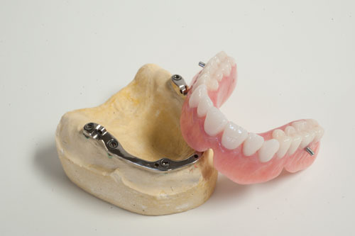 Quels sont les différents types de prothèses dentaires? - Francis Migneault d.d.