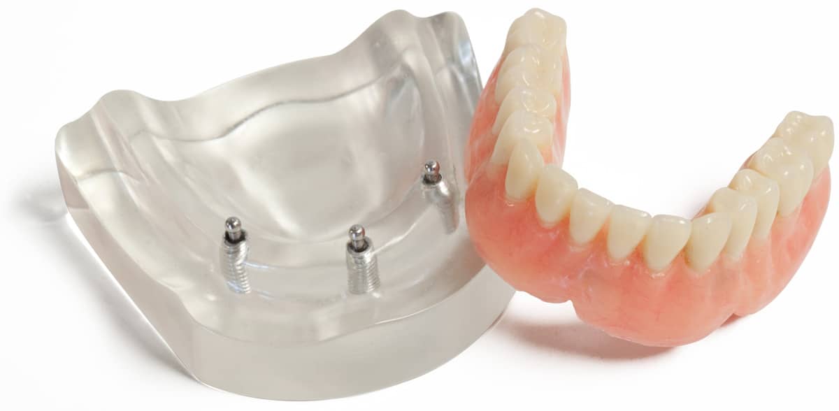 Prothèse dentaire sur implants